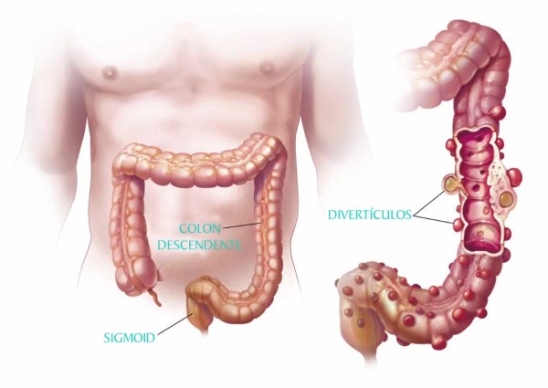 Imagem do procedimento DOENÇA DIVERTICULAR,  DIVERTICULITE E ESTENOSE DIVERTICULAR