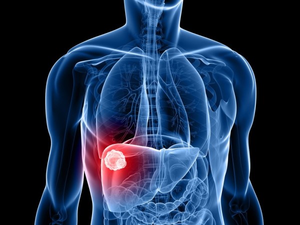 Imagem do procedimento HEMANGIOMAS E OUTROS NÓDULOS HEPÁTICOS BENIGNOS