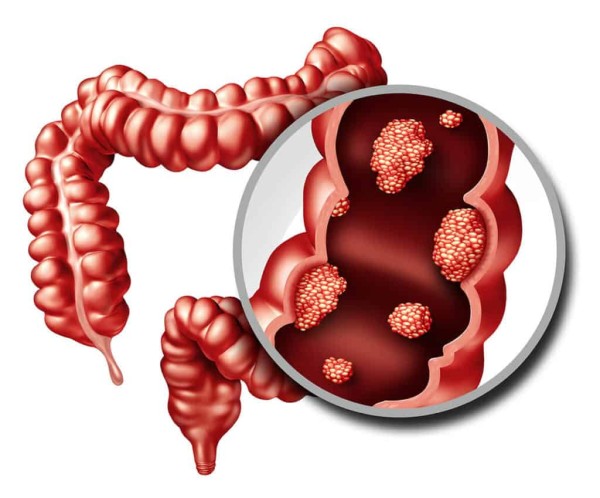 Imagem do procedimento PÓLIPOS DO INTESTINO OU PÓLIPOS COLÔNICOS